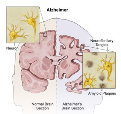 alzheimers-diagram-brain22222-3.jpg
